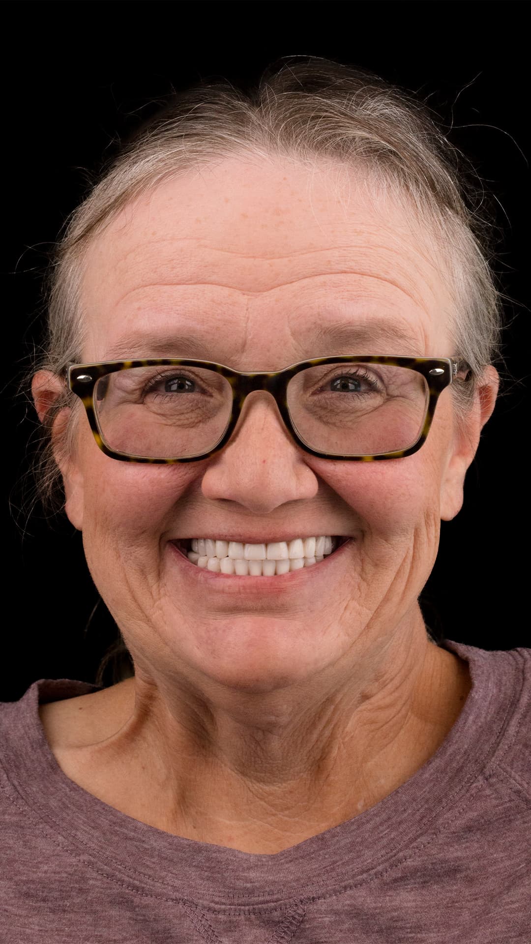 Before: Complete Smile Makeover