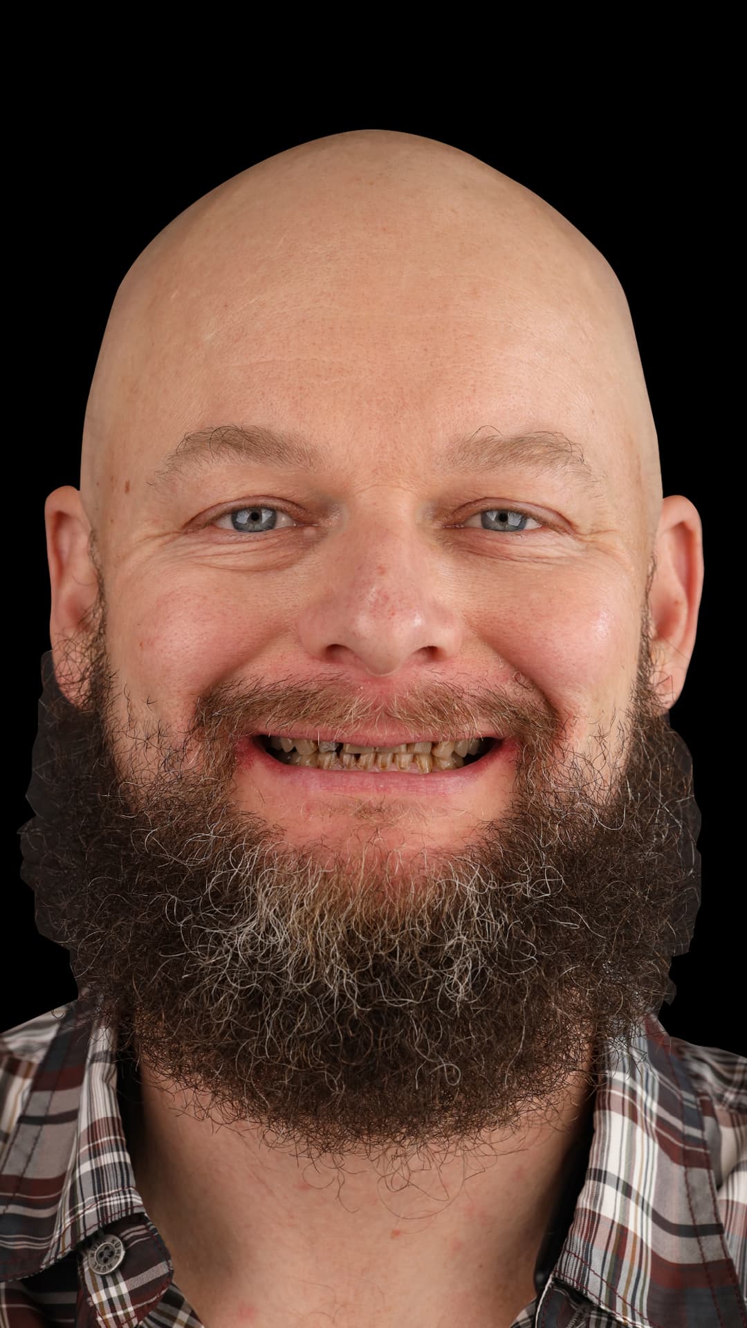 Before: Complete Dental Restoration