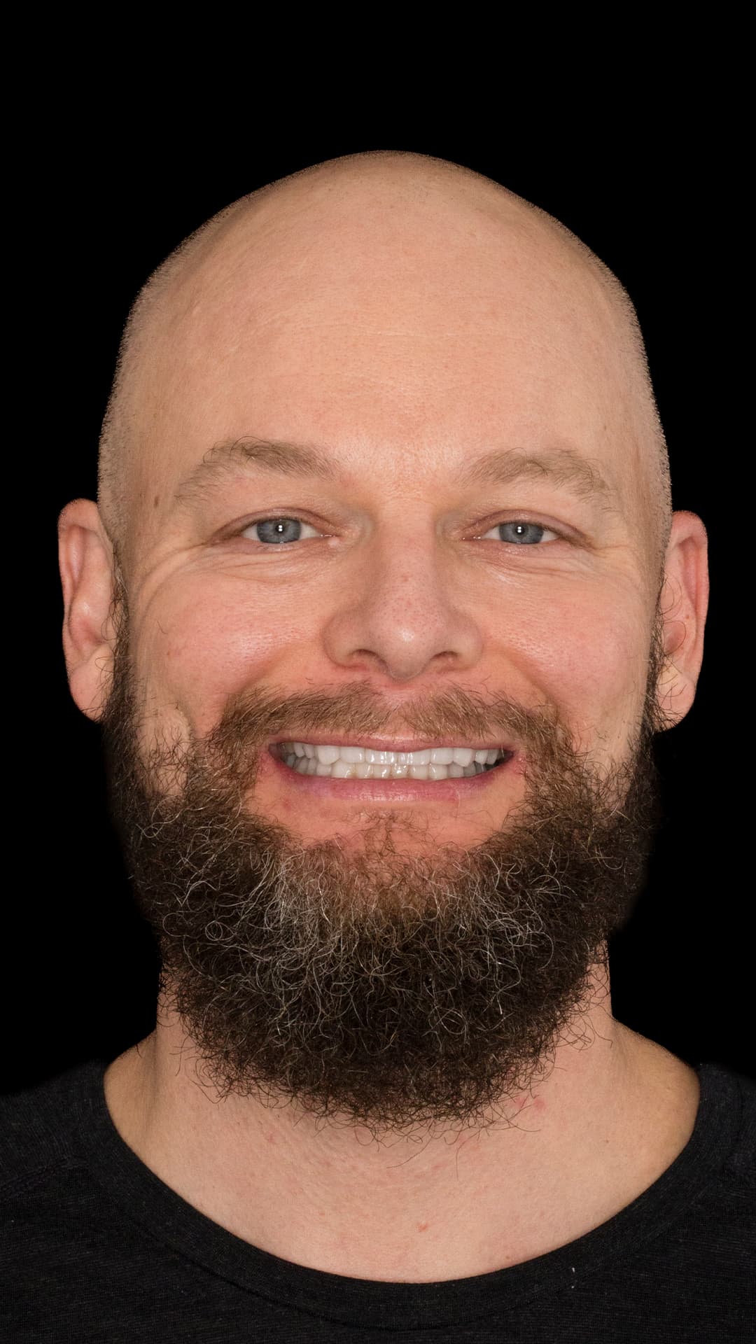 After: Complete Dental Restoration