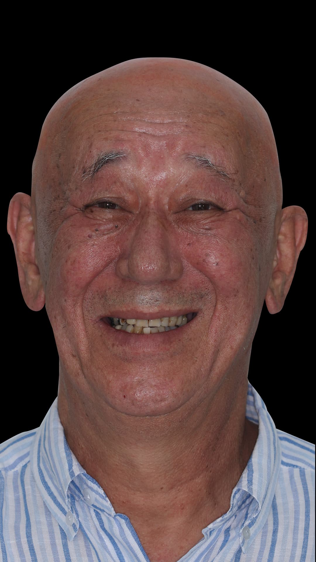 Before: Complete Dental Restoration