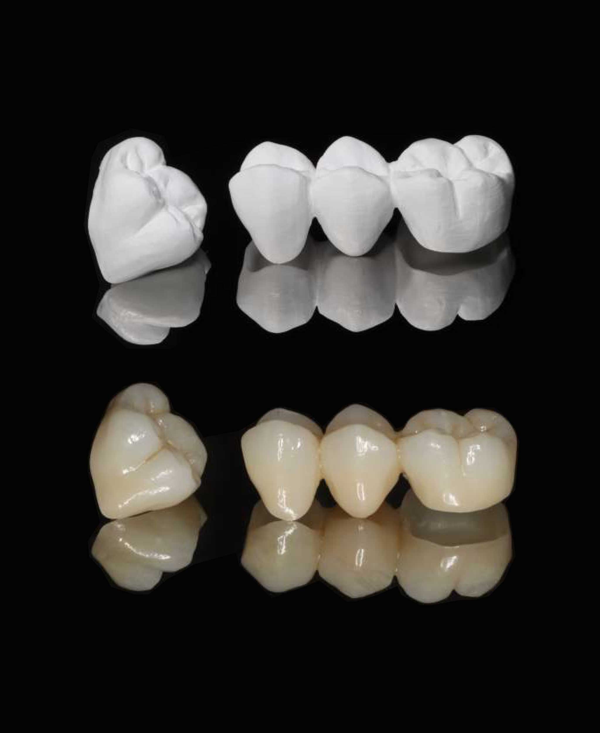 Zirconium dental crowns and bridges crafted with Cad Cam technology