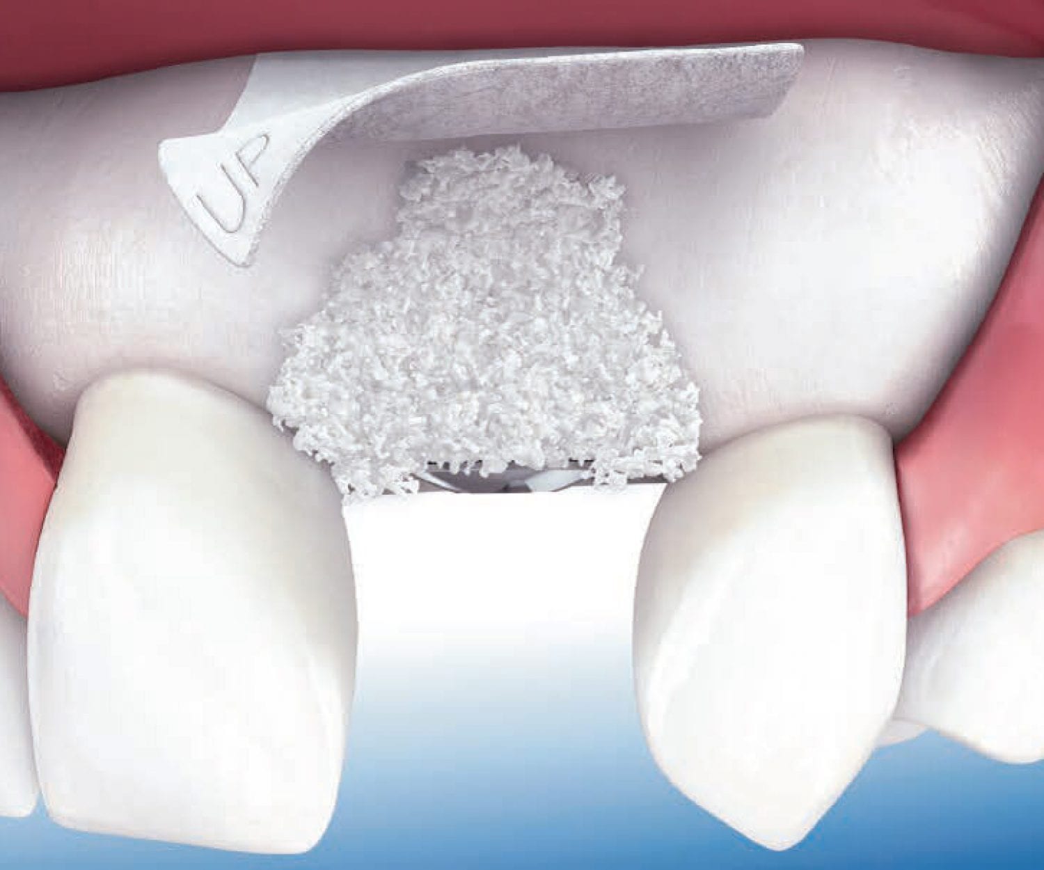 Bone Graft and Membrane Procedure at America Dental Clinic