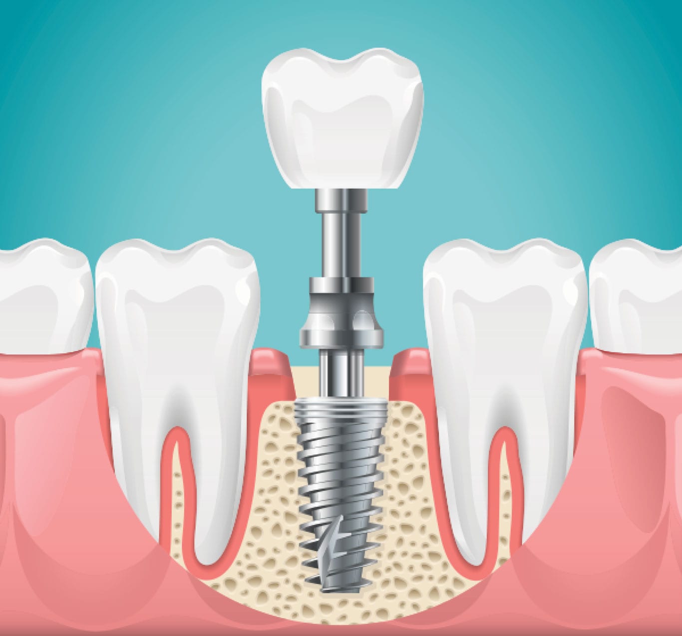 ☎️ ALL ON 4 DENTAL IMPLANTS COSTA RICA ⭐ America Dental